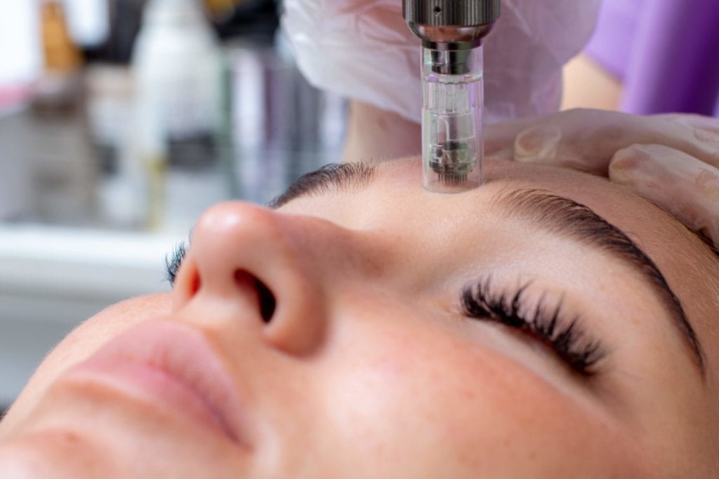 Microneedling for Acne Scars: Treatment Options and Success Stories 2 Microneedling Treatment by Lakeside Aesthetics and Skincare in Horseshoe Bay, TX