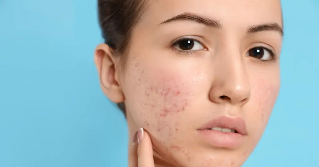 How Medical-Grade Skincare Can Help Treat Acne and Hyperpigmentation 1 Close-up of a woman with acne and redness on her cheeks touching her face against a blue background, representing Medical-Grade Skincare in Horseshoe Bay, TX.